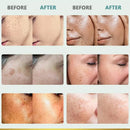 Powerful Spot-removing Whiten Cream Brighten Skin Fast Eliminates Melanin Pigmentation Melasma Dark Spots Moisturize Beauty Gel